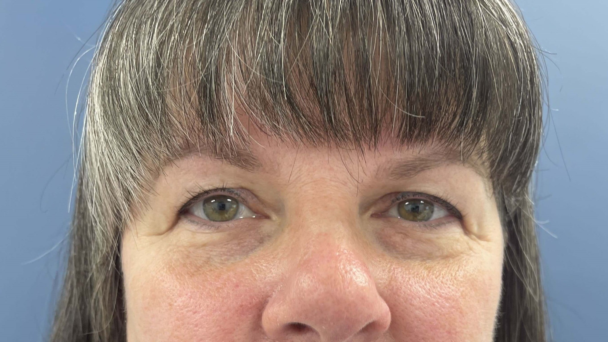 Benefits of Upper Blepharoplasty – Eyelid Surgery