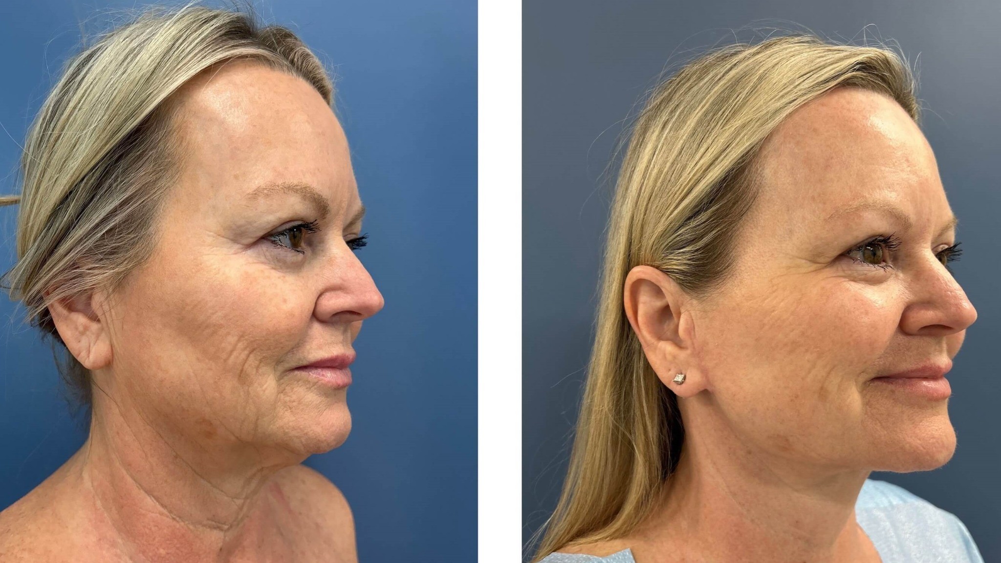 Isolated Neck Lift-Improves Sagging Neck Line