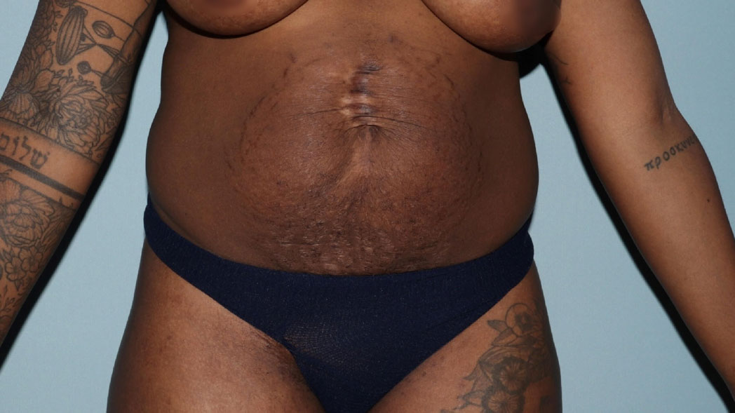 Tummy Tuck with Prior Ugly Abdominal Scars – a Difficult Case