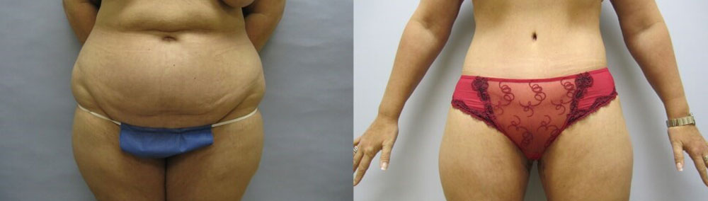 before and after mommy makeover after weight loss with Dr. Lyle