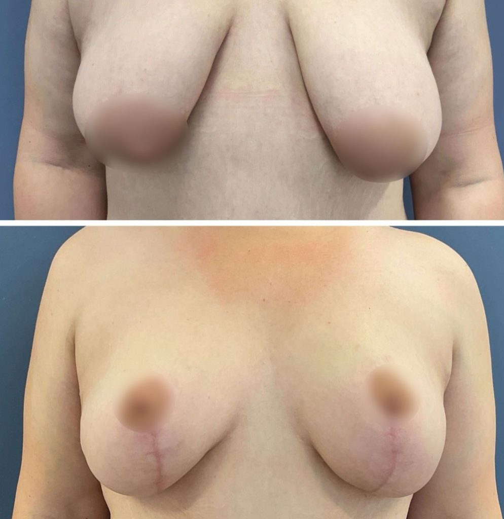 before and after a lollipop lift with Dr. Glenn Lyle