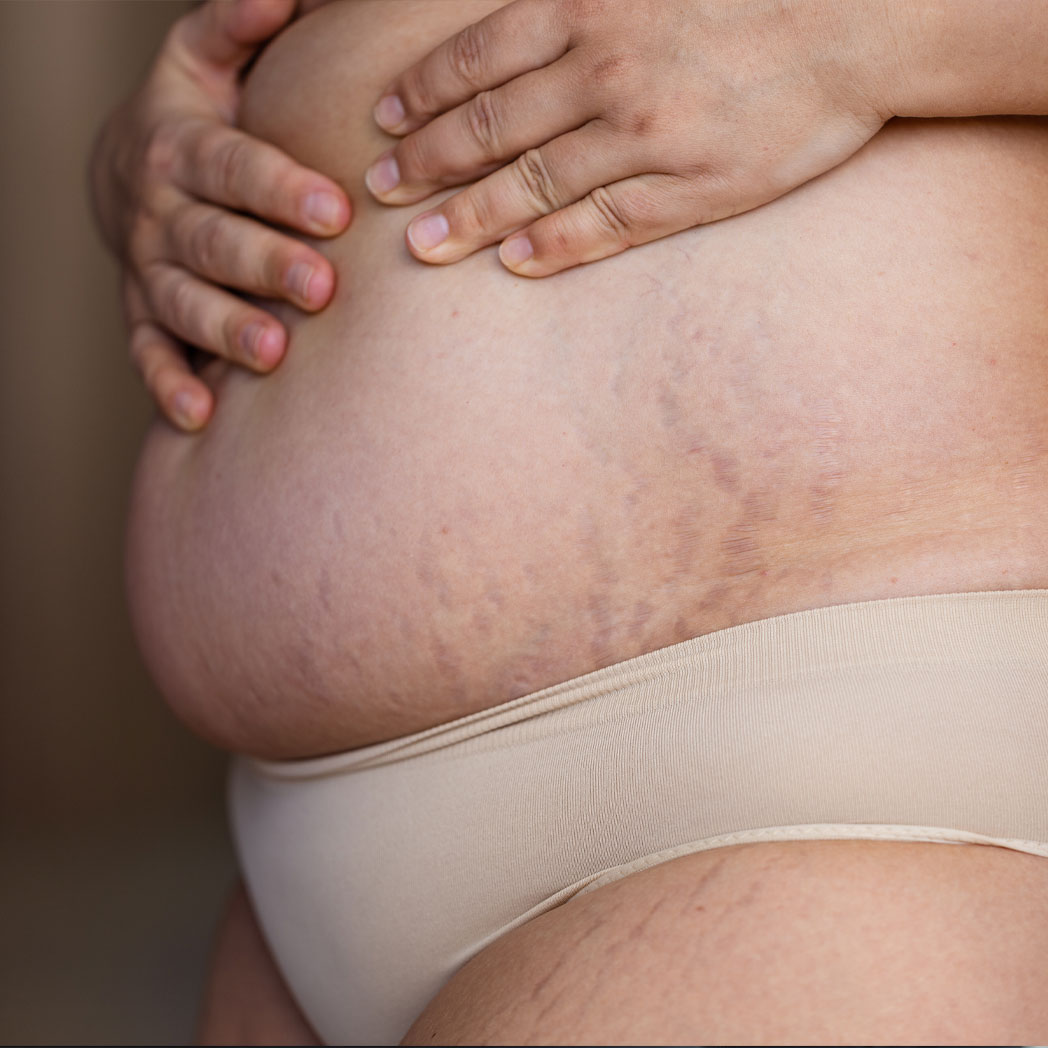 Will a Tummy Tuck Get Rid of Stretch Marks?