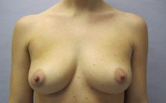 before breast augmentation front view female patient case 2696