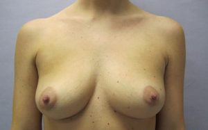 before breast augmentation front view female patient case 2696