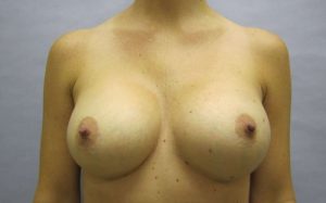 after breast augmentation front view female patient case 2696