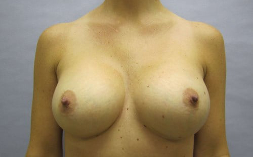 after breast augmentation front view female patient case 2696