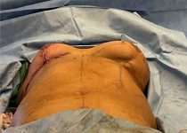 image during breast implant removal and lift - case 4417