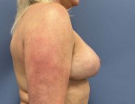 image after breast implant removal and lift - right angle case 4417