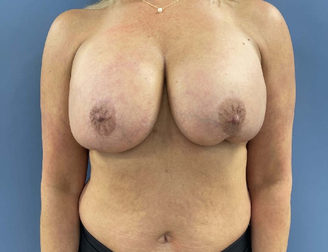 image before breast implant removal and lift - front view case 4417