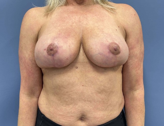 image after breast implant removal and lift - front view case 4417