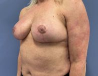 image after breast implant removal and lift - left angle case 4417