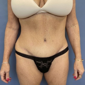 after abdominoplasty - tummy tuck front view case 3813