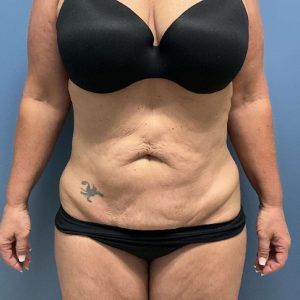 Before Image of Tummy Tuck with Hernia Repair Front Side View Case- 3653