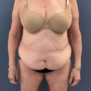 before tummy tuck - over 50 years old patient front view case 3729