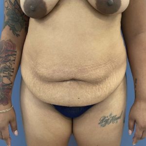 before tummy tuck front view case 3754
