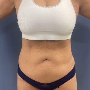 before tummy tuck - vaser liposuction front view case 3770