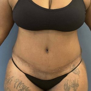 after tummy tuck - flatter abs front view case 3779
