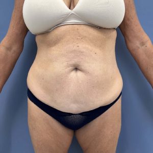 before abdominoplasty - tummy tuck front view case 3813