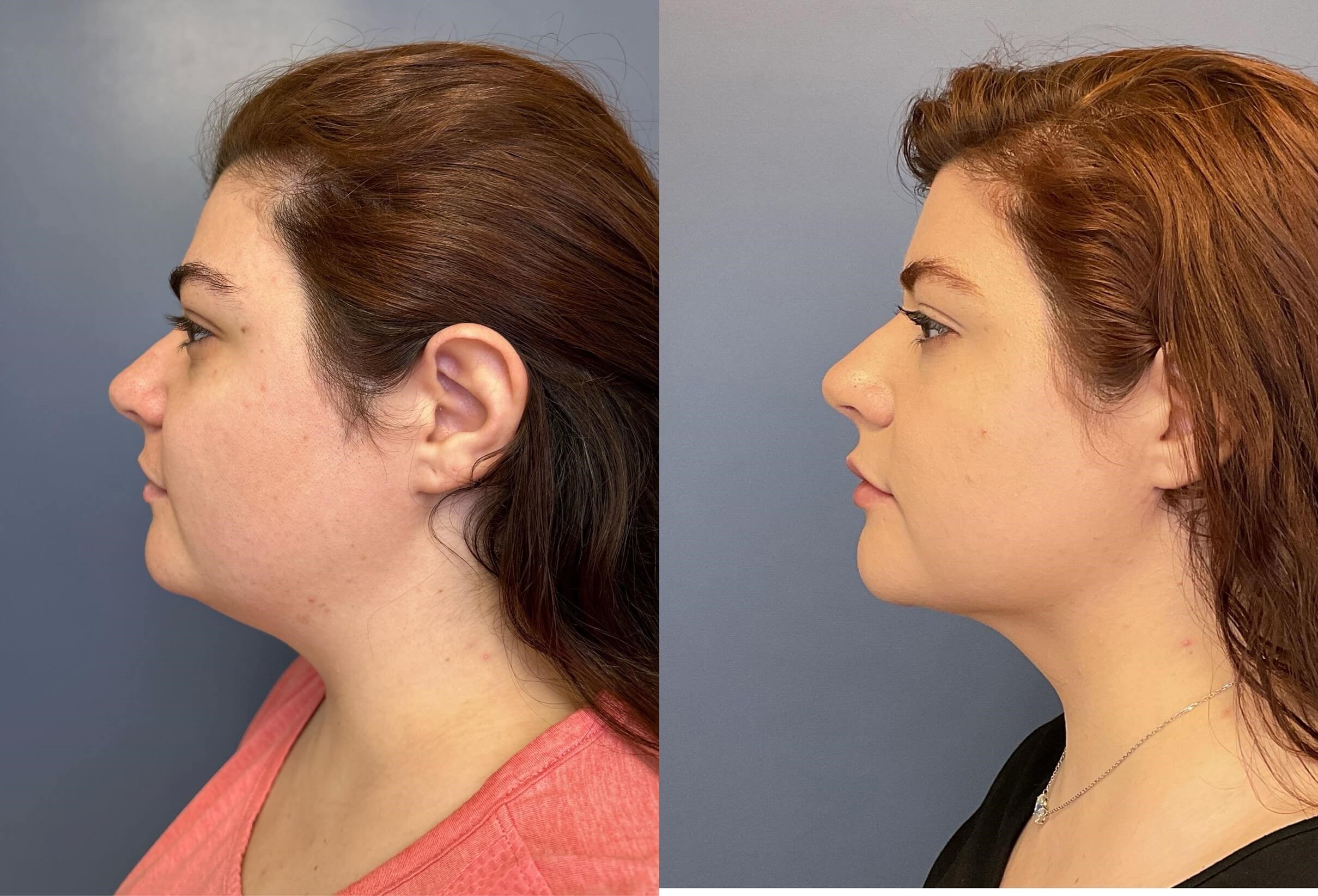 Submental Liposuction – An Effective Procedure for Neck Contouring
