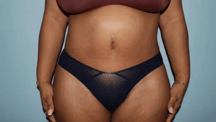 How to Lose Weight Before Your Plastic Surgery: A Guide for Dr. Lyle’s Patients