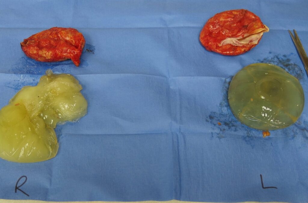 Ruptured breast implants