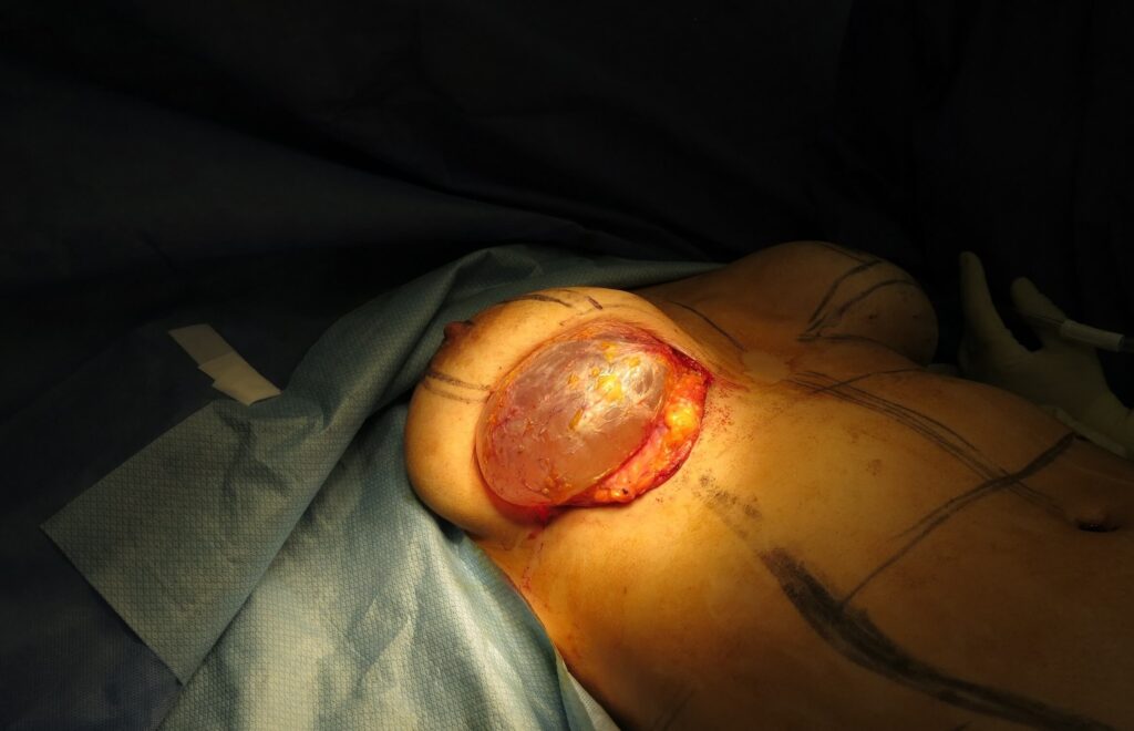 Saline implant