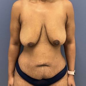 before mommy makeover front view female patient case 5448