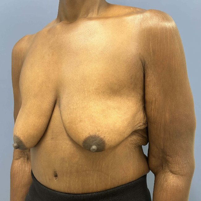 before After Weight Loss Surgery female patient angle view case 5429