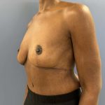 after After Weight Loss Surgery female patient angle view case 5429