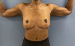 after After Weight Loss Surgery female patient front view case 5429