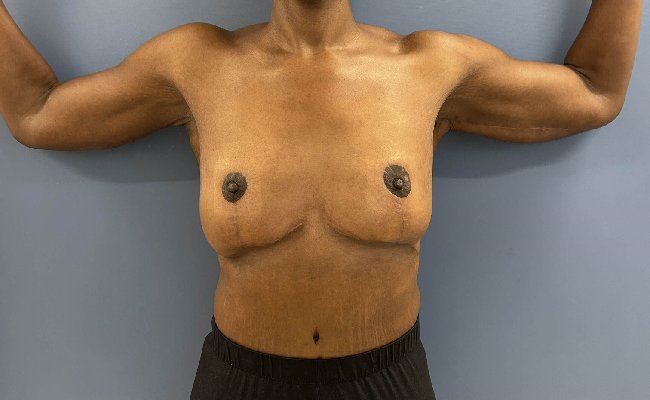 after After Weight Loss Surgery female patient front view case 5429