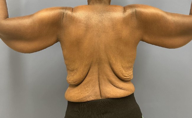 before After Weight Loss Surgery female patient back view case 5429