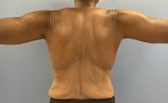 after After Weight Loss Surgery female patient back view case 5429