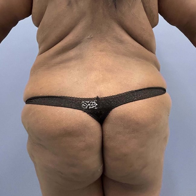 before After Weight Loss Surgery female patient back view case 5437