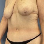 after After Weight Loss Surgery left angle view female patient case 7803