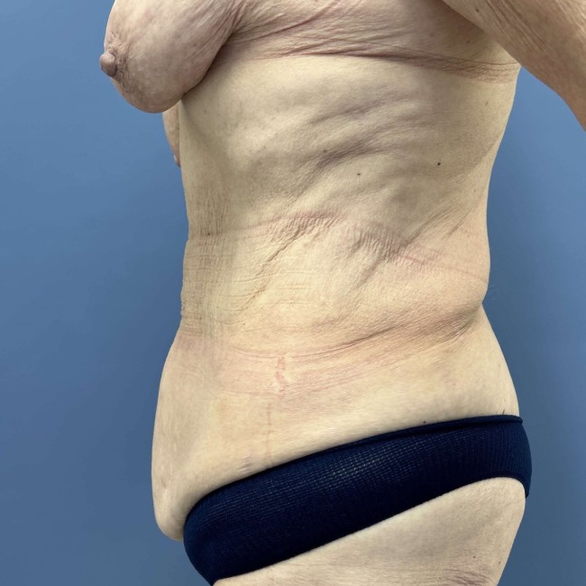 before After Weight Loss Surgery left side view female patient case 7803
