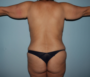 Before Arm lift Before and After Photo Back View Case 6564