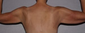 before brachioplasty and breast augmentation back view case 6551