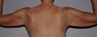 before brachioplasty and breast augmentation back view case 6551