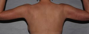 after brachioplasty and breast augmentation back view case 6551