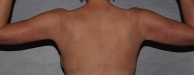 after brachioplasty and breast augmentation back view case 6551