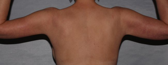 after brachioplasty and breast augmentation back view case 6551