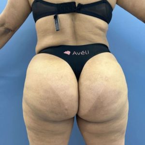 After Image of Aveli for Buttock Dimpling With BBL Back Side View Case 6989