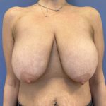 before Breast lift with Implants female patient front view case 7816