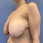 before Breast lift with Implants female patient left side view case 7816