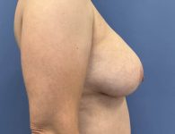 image before breast implant removal and mastopexy with fat transfer- right angle case 5523