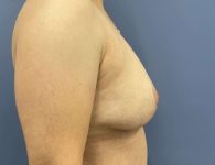 image after breast implant removal and mastopexy with fat transfer- right angle case 5523