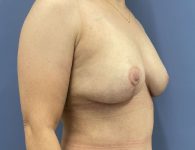 image after breast implant removal and mastopexy with fat transfer- 45 degrees right angle case 5523