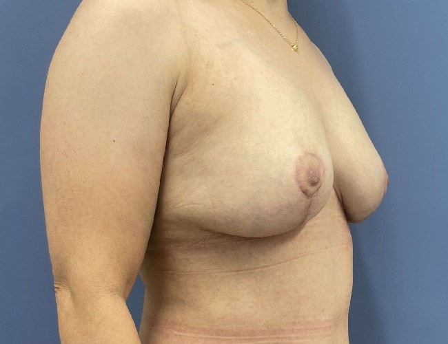 image after breast implant removal and mastopexy with fat transfer- 45 degrees right angle case 5523