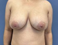 image before breast implant removal and mastopexy with fat transfer- front view case 5523